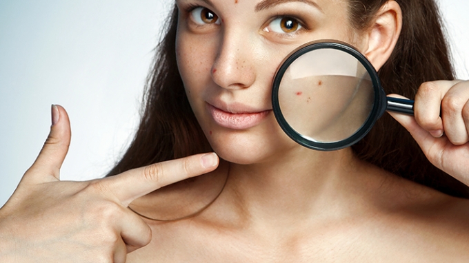 How To Control And Treat Acne During Pregnancy Pregnancy Health