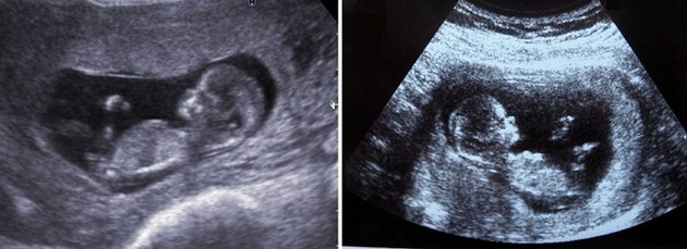 11 Weeks 5 Days Pregnant Ultrasound Gender