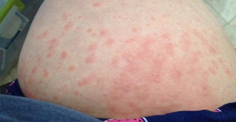 What Causes Of Skin Rashes During Pregnancy Pregnancy Health