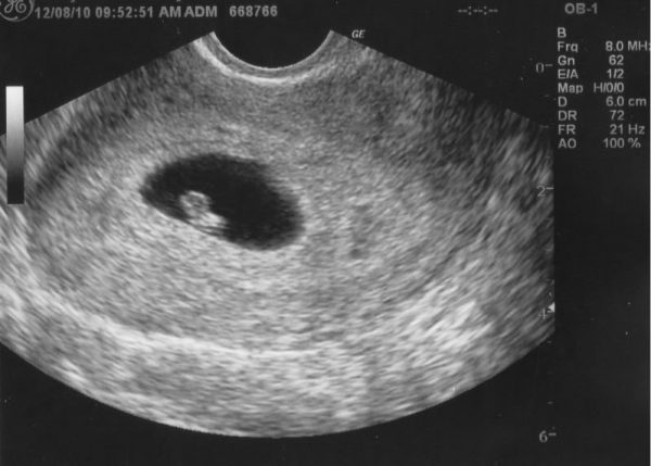 6 Weeks Pregnant Symptoms Ultrasound Spotting And Cramping 