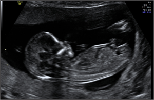 13 Weeks Pregnancy Ultrasound